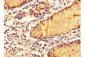 Immunohistochemistry of paraffin-embedded human colon cancer using ABIN7170420 at dilution of 1:100 (SMOC1 抗体  (AA 277-382))