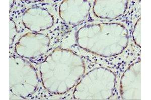 Immunohistochemistry of paraffin-embedded human colon cancer using ABIN7172096 at dilution of 1:100 (THBS3 抗体  (AA 787-956))