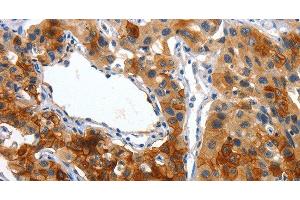 Immunohistochemistry of paraffin-embedded Human lung cancer using Placental Alkaline Phosphatase Polyclonal Antibody at dilution of 1:50 (PLAP 抗体)