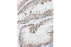 Anti-MEKK1 antibody, IHC(P) IHC(P): Human Intestinal Cancer Tissue