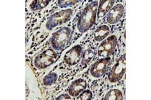 Immunohistochemical analysis of FBL5 staining in human colon cancer formalin fixed paraffin embedded tissue section. (FBXL4 抗体)
