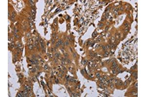 The image on the left is immunohistochemistry of paraffin-embedded Human colon cancer tissue using ABIN7191746(OSM Antibody) at dilution 1/40, on the right is treated with synthetic peptide. (Oncostatin M 抗体)