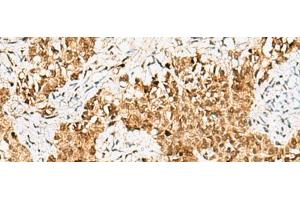 Immunohistochemistry of paraffin-embedded Human ovarian cancer tissue using CRCP Polyclonal Antibody at dilution of 1:65(x200) (CRCP 抗体)