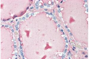 Human Thyroid (formalin-fixed, paraffin-embedded) stained with TG antibody ABIN396965 at 10 ug/ml followed by biotinylated anti-mouse IgG secondary antibody ABIN481714, alkaline phosphatase-streptavidin and chromogen. (Thyroglobulin 抗体)