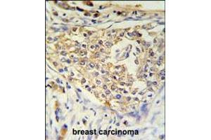 ADFP Antibody IHC analysis in formalin fixed and paraffin embedded breast carcinoma followed by peroxidase conjugation of the secondary antibody and DAB staining. (ADRP 抗体  (AA 186-214))