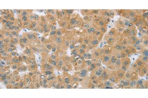 Immunohistochemistry of paraffin-embedded Human liver cancer tissue using CYP2C9 Polyclonal Antibody at dilution 1:35 (CYP2C9 抗体)