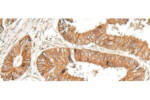Immunohistochemistry of paraffin-embedded Human colorectal cancer tissue using GFI1 Polyclonal Antibody at dilution of 1:100(x200) (GFI1 抗体)
