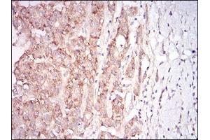 Immunohistochemical analysis of paraffin-embedded liver cancer tissues using MSTN mouse mAb with DAB staining.