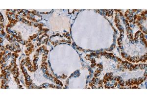 Immunohistochemistry of paraffin-embedded Human thyroid cancer tissue using CMC4 Polyclonal Antibody at dilution 1:55 (CMC4 抗体)