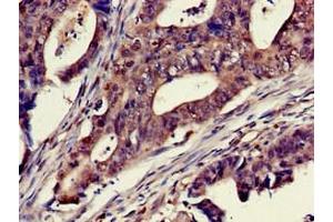 Immunohistochemistry of paraffin-embedded human colon cancer using ABIN7150733 at dilution of 1:100 (Mps1 抗体  (AA 370-492))