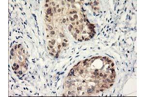 Immunohistochemical staining of paraffin-embedded Adenocarcinoma of Human breast tissue using anti-LPL mouse monoclonal antibody. (Lipoprotein Lipase 抗体  (AA 28-475))