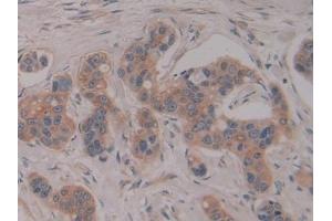 Detection of PSG1 in Human Breast cancer Tissue using Polyclonal Antibody to Pregnancy Specific Beta-1-Glycoprotein 1 (PSG1) (PSG1 抗体  (AA 202-401))