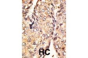Formalin-fixed and paraffin-embedded human cancer tissue reacted with the primary antibody, which was peroxidase-conjugated to the secondary antibody, followed by DAB staining. (GDF10 抗体  (N-Term))