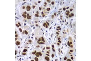 Immunohistochemistry of paraffin-embedded human gastric cancer using SF3B2 antibody (ABIN5973482) at dilution of 1/100 (40x lens).