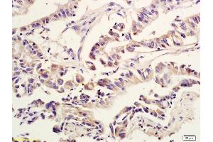 Formalin-fixed and paraffin embedded human colon cancer labeled with Anti Amphiregulin Polyclonal Antibody, Unconjugated  at 1:600 followed by conjugation to the secondary antibody and DAB staining (Amphiregulin 抗体  (AA 185-252))