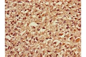 Immunohistochemistry of paraffin-embedded human melanoma using ABIN7159613 at dilution of 1:100 (MBD3 抗体  (AA 79-209))