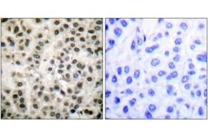 Immunohistochemistry analysis of paraffin-embedded human breast carcinoma tissue, using MEF2A (Ab-408) Antibody. (MEF2A 抗体  (AA 374-423))