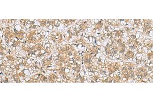 Immunohistochemistry of paraffin-embedded Human liver cancer tissue using LFNG Polyclonal Antibody at dilution of 1:60(x200) (LFNG 抗体)