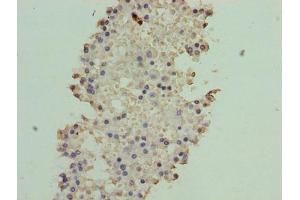 Immunohistochemistry of paraffin-embedded human breast cancer using ABIN7144801 at dilution of 1:100 (ATXN7L1 抗体  (AA 1-146))