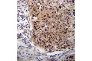 Formalin fixed and paraffin embedded human esophageal carcinoma reacted with EXTL3 Antibody (N-term) followed by peroxidase conjugation of the secondary antibody and DAB staining. (EXTL3 抗体  (N-Term))