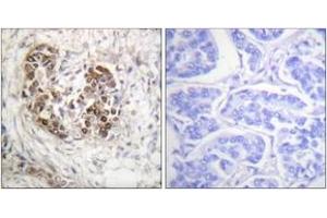 Immunohistochemistry analysis of paraffin-embedded human breast carcinoma tissue, using p53 (Ab-20) Antibody. (p53 抗体  (AA 10-59))