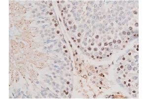 Immunohistochemistry (IHC) image for anti-Signal Transducer and Activator of Transcription 3 (Acute-Phase Response Factor) (STAT3) (pTyr705) antibody (ABIN6255995)