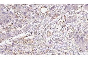 ABIN6273935 at 1/100 staining Human liver cancer tissue by IHC-P. (GPR39 抗体  (C-Term))