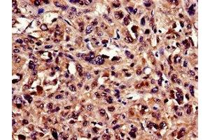 Immunocytochemistry analysis of human melanoma using ABIN7174228 at dilution of 1:100 (Ubiquilin 2 抗体  (AA 473-542))