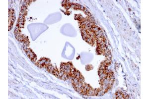 Formalin-fixed, paraffin-embedded human Prostate Carcinoma stained with PMEPA1 Mouse Monoclonal Antibody (PMEPA1/2696).