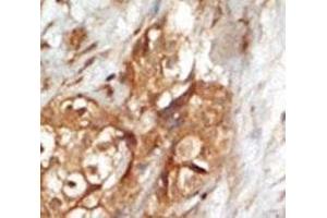 IHC analysis of FFPE human breast carcinoma tissue stained with the NIK antibody (MAP3K14 抗体  (AA 119-148))