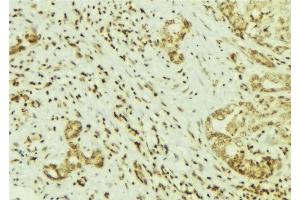 ABIN6269141 at 1/100 staining Human breast cancer tissue by IHC-P. (Src 抗体  (N-Term))
