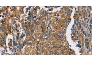 Immunohistochemistry of paraffin-embedded Human cervical cancer tissue using TAC1 Polyclonal Antibody at dilution 1:25 (TAC1 抗体)