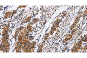 Immunohistochemistry of paraffin-embedded Human gasrtic cancer tissue using NCAPD3 Polyclonal Antibody at dilution 1:50 (NCAPD3 抗体)
