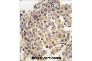 Forlin-fixed and paraffin-embedded hun breast carcino tissue reacted with P2K1 Antibody  (ABIN1881525 and ABIN2842060) , which was peroxidase-conjugated to the secondary antibody, followed by DAB staining. (MEK1 抗体  (AA 270-299))