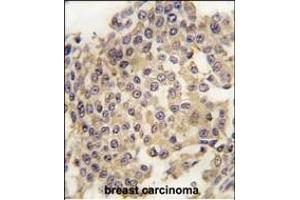 Forlin-fixed and paraffin-embedded hun breast carcino tissue reacted with P2K1 Antibody  (ABIN1881525 and ABIN2842060) , which was peroxidase-conjugated to the secondary antibody, followed by DAB staining.