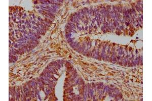 IHC image of ABIN7142780 diluted at 1:600 and staining in paraffin-embedded human ovarian cancer performed on a Leica BondTM system. (RPL26 抗体  (AA 48-143))