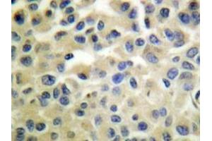 Immunohistochemistry analyzes of IKKα/β antibody in paraffin-embedded human breast carcinoma tissue. (IKK alpha 抗体)