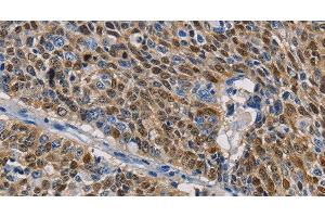 Immunohistochemistry of paraffin-embedded Human lung cancer tissue using GSTA2 Polyclonal Antibody at dilution 1:50