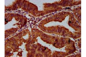 IHC image of ABIN7148760 diluted at 1:600 and staining in paraffin-embedded human endometrial cancer performed on a Leica BondTM system. (Cullin 7 抗体  (AA 312-450))