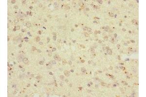 Immunohistochemistry of paraffin-embedded human glioma using ABIN7167625 at dilution of 1:100 (RGS 抗体  (AA 230-350))