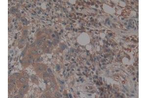 IHC-P analysis of Human Breast cancer Tissue, with DAB staining. (TEP1 抗体  (AA 2368-2627))