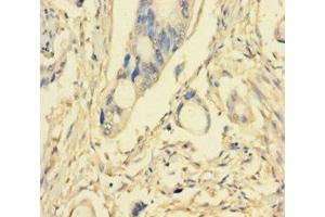 Immunohistochemistry of paraffin-embedded human pancreatic cancer using ABIN7163295 at dilution of 1:100 (PIK3R5 抗体  (Regulatory Subunit 5))