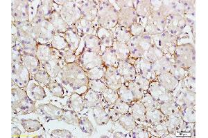 Formalin-fixed and paraffin embedded human colon carcinoma tissue labeled with Rabbit Anti-RAB7 Polyclonal Antibody at 1:200 followed by conjugation to the secondary antibody and DAB staining. (RAB7A 抗体  (AA 101-207))