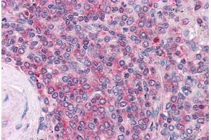 Immunohistochemistry (Formalin-fixed Paraffin-embedded Sections) (IHC (fp)) image for anti-Platelet Derived Growth Factor Receptor alpha (PDGFRA) (AA 331-719) antibody (ABIN604925)