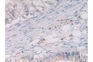 IHC-P analysis of Human Rectum Cancer Tissue, with DAB staining. (Cathepsin S 抗体  (AA 115-331))