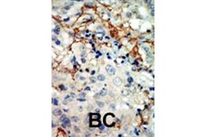 Formalin-fixed and paraffin-embedded human cancer tissue reacted with the primary antibody, which was peroxidase-conjugated to the secondary antibody, followed by AEC staining. (EPH Receptor A3 抗体  (N-Term))