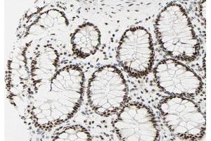 ABIN6267281 at 1/200 staining human colon carcinoma sections by IHC-P. (RAF1 抗体  (pSer259))