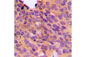 Immunohistochemical analysis of NT5C1B staining in human breast cancer formalin fixed paraffin embedded tissue section. (NT5C1B 抗体  (Center))