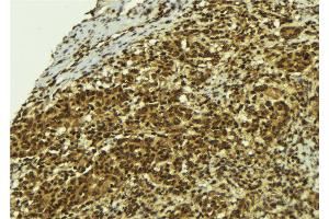 ABIN6273779 at 1/100 staining Human breast cancer tissue by IHC-P. (BCL2L13 抗体  (Internal Region))