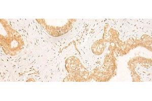 Immunohistochemistry of paraffin-embedded Human breast cancer tissue using GSG1L Polyclonal Antibody at dilution of 1:50(x200) (GSG1-Like 抗体)